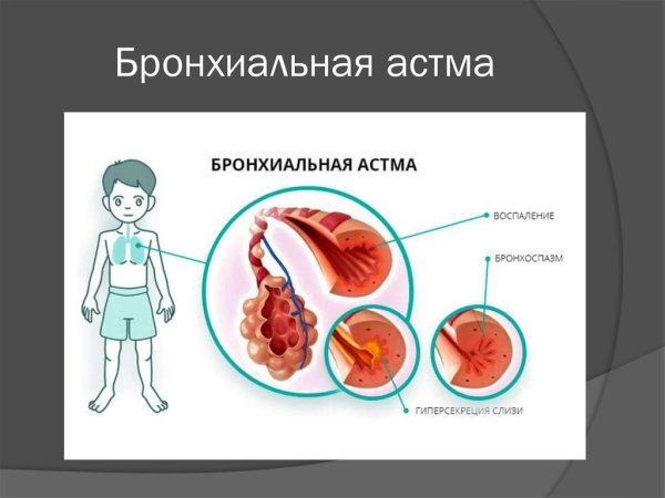 Бронхиальная астма