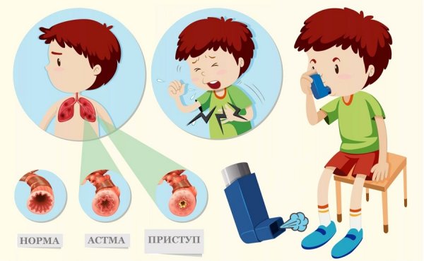 Бронхиальная астма иллюстрация