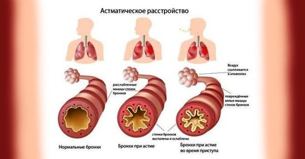 Бронхиальная астма локализация