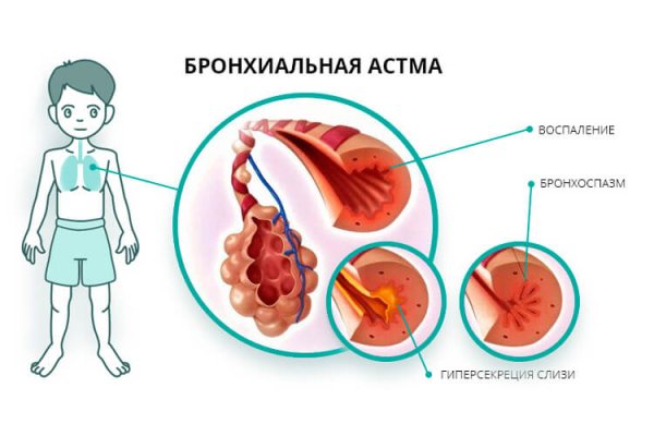Бронхиальная астма бронхи