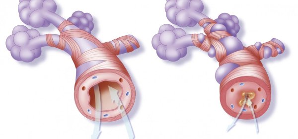 Бронхиальная астма бронхоспазм