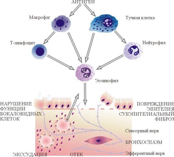 Клетки участвующие в воспалении при бронхиальной астме