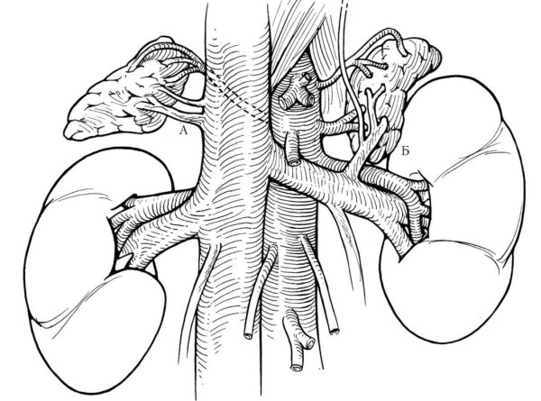 Шваннома надпочечника