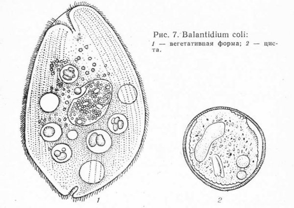 Циста балантидия