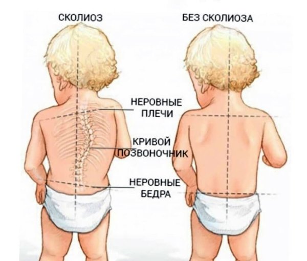 Сколиоз позвоночника у детей