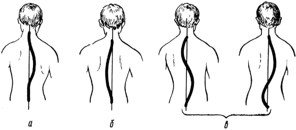 Формы искривления сколиоза