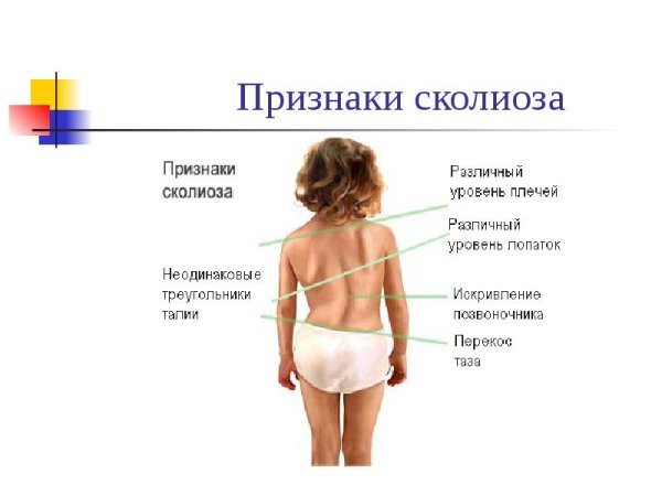 Искривление позвоночника симптомы