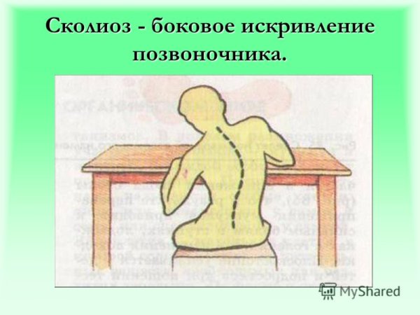 Сколиоз боковое искривление позвоночника