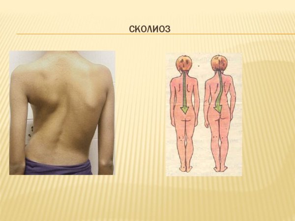 Неструктурный сколиоз