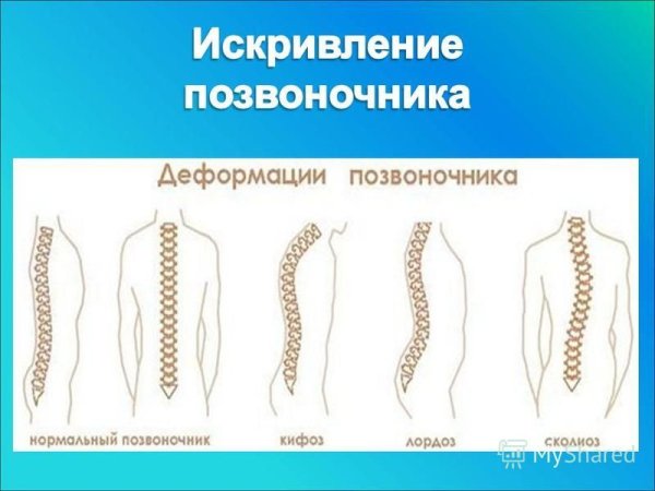 Типы искривления позвоночника