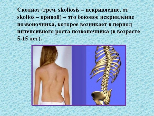 Боковое искривление позвоночника