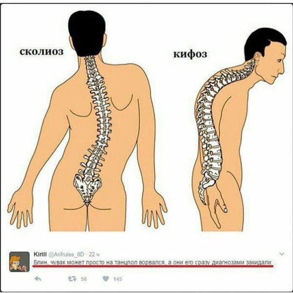 Лордоз кифоз сколиоз