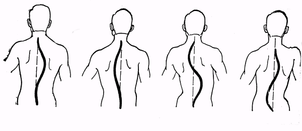 Сколиоз позвоночника схема