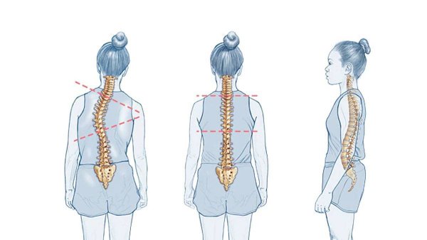 Строение позвоночника сколиоз