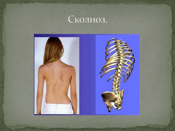 Сколиоз позвоночника анатомия