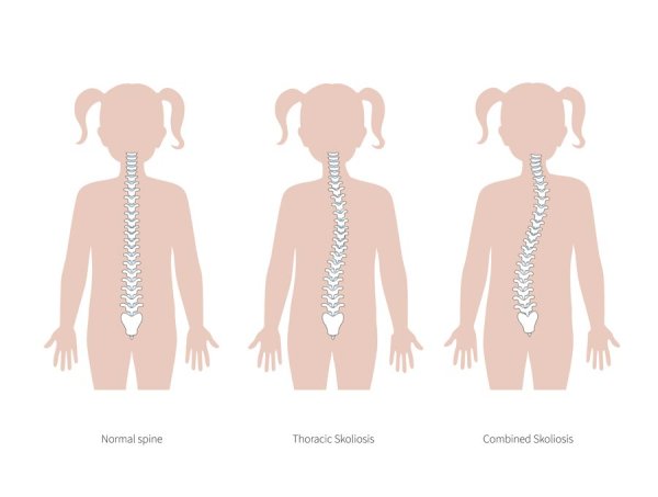 Искривление позвоночника рисунок для детей