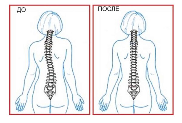 Сколиоз мкб у детей