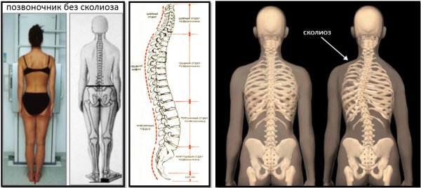 Деформации позвоночника ( сколиоз, лордоз, гиперкифоз)