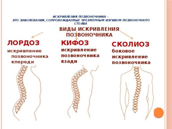 Нарушение осанки лордоз кифоз сколиоз