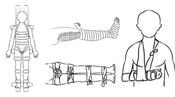 Шина на открытый перелом голени