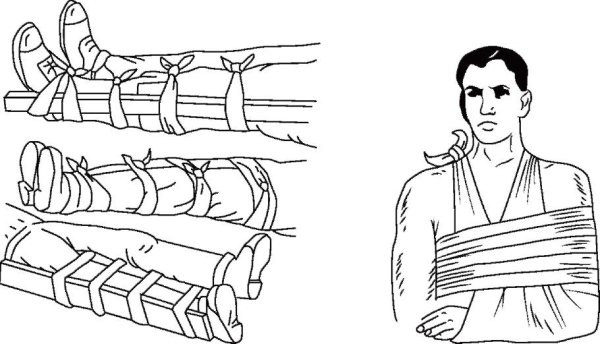 Закрытый перелом перевязка