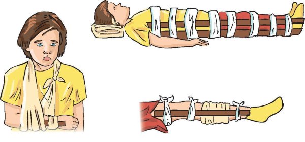Перелом диафиза большеберцовой кости