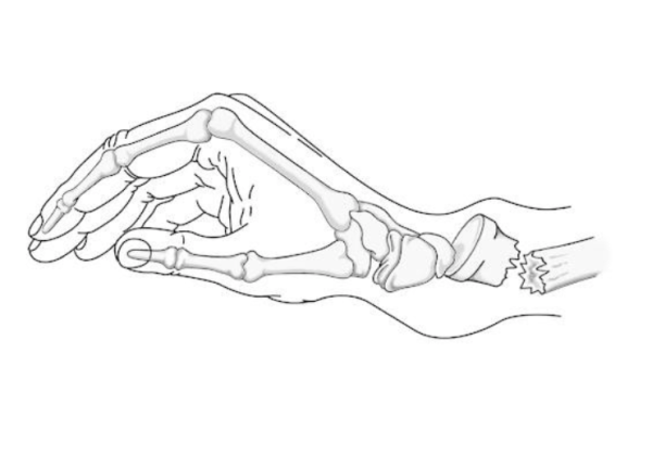 Перелом Монтеджа Галеацци