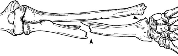 Закрытый перелом голени презентация