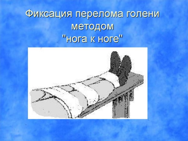 Сломанная кость вектор