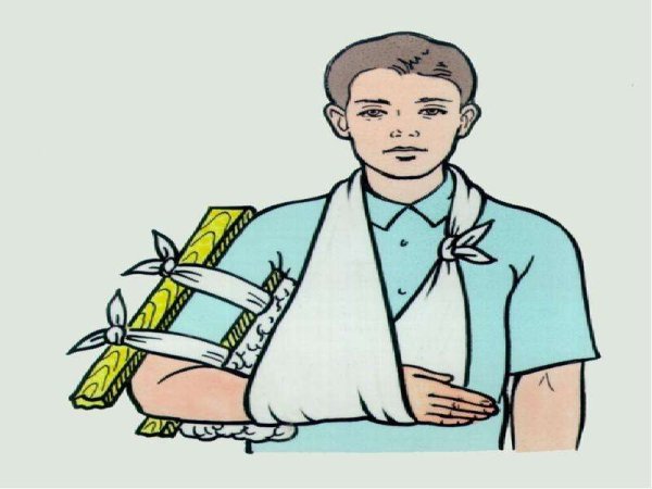 Иммобилизация конечности при переломе костей кисти и пальцев