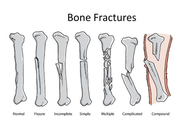 ПМП при переломе голени