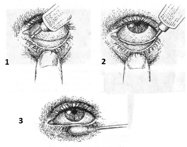 Закладывание мази в конъюнктивальный мешок