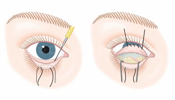 Нижний конъюнктивальный мешок глаза