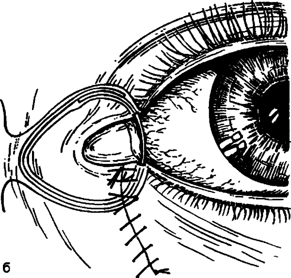 Конъюнктивальный мешок глазной