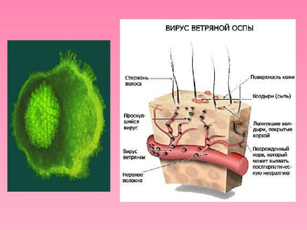 Вирус ветряной оспы схема
