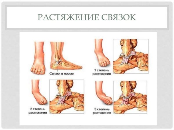 Растяжение и разрыв связок симптомы