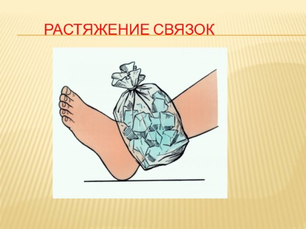 Растяжение схематичный рисунок