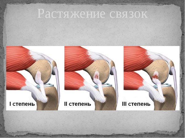 Как выглядит растяжение