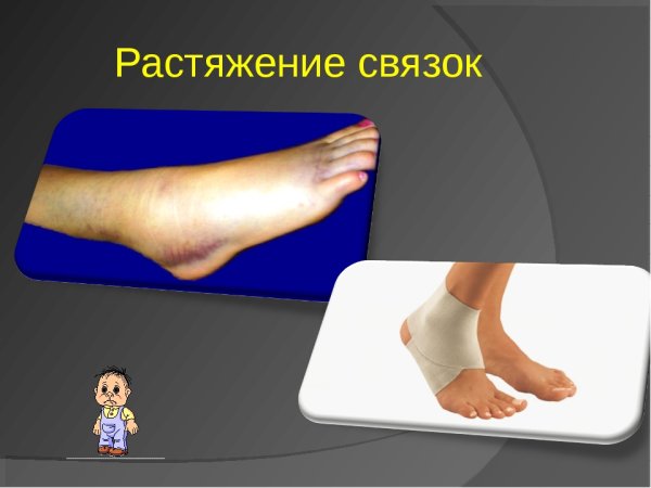 Первая помощь при растяжении мышц