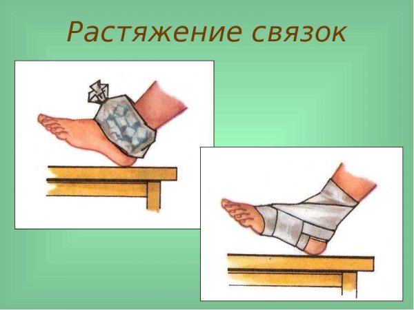 Растяжения, разрывы связок и мышц