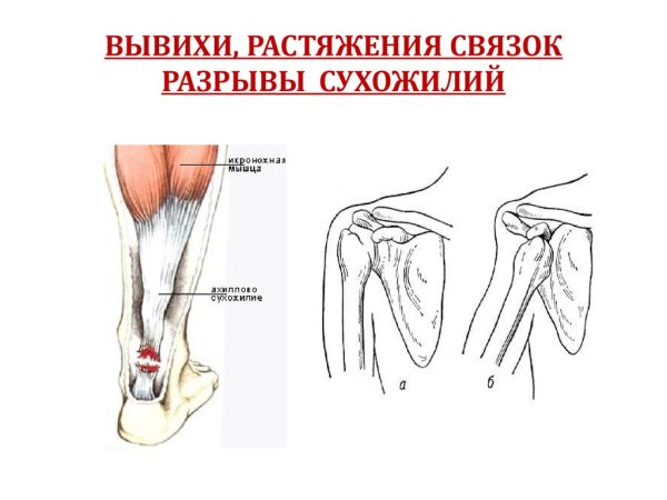 Растяжение доклад по биологии