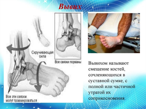 Повреждение связок 2 голеностопа степени