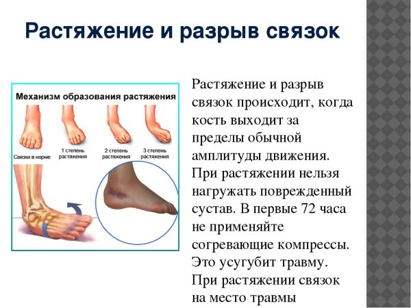 Растяжения и разрывы связок и сухожилий