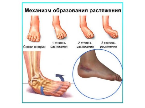 Вправление вывиха голеностопного сустава