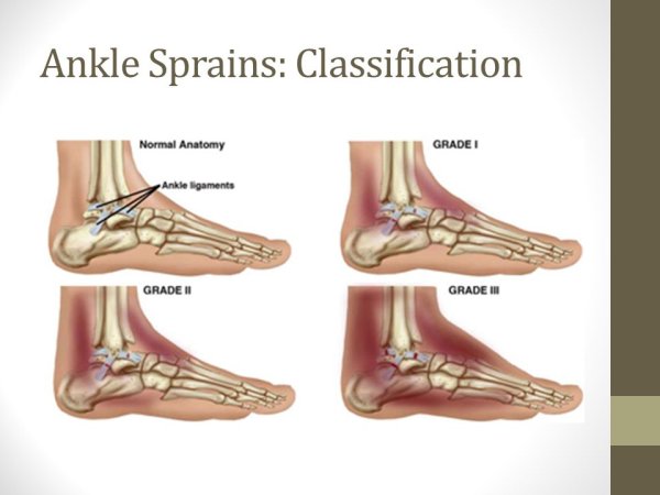 ПМП при растяжении связок
