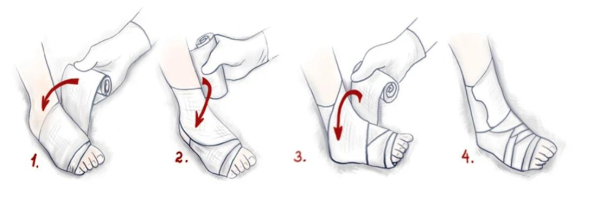 Растяжения связок голеностопного сустава код мкб 10