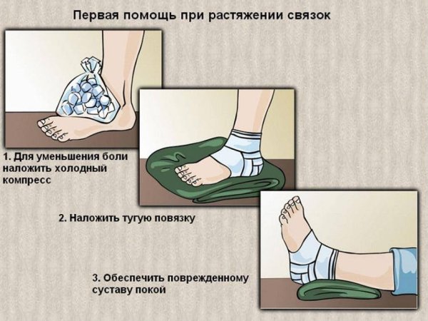 Растяжение связок первая помощь