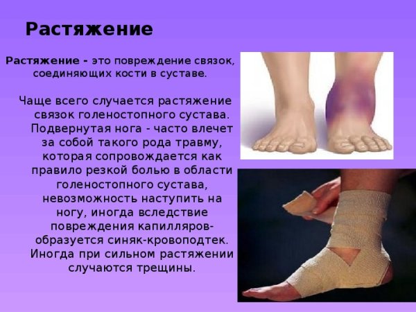 Разрыв связок голеностопа на стопе