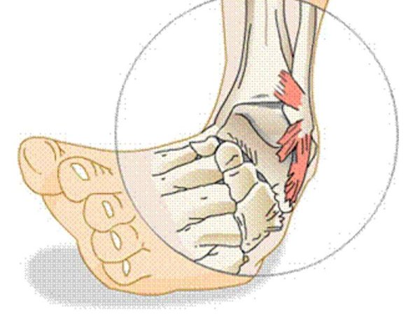 Растяжение связок голеностопного сустава 1 степени