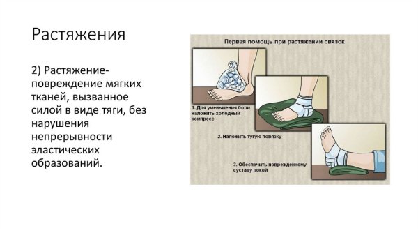 Вывих растяжение ступни